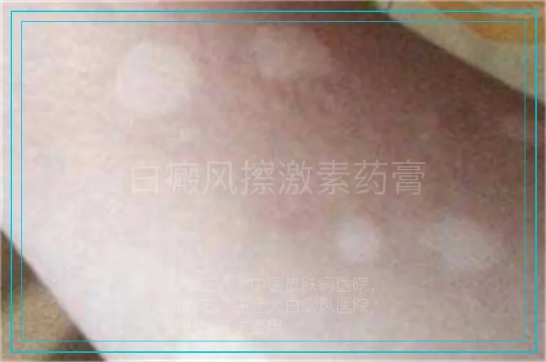 白癜风擦激素药膏