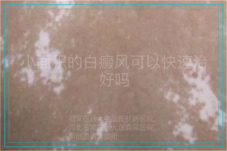 小面积的白癜风可以快速治好吗
