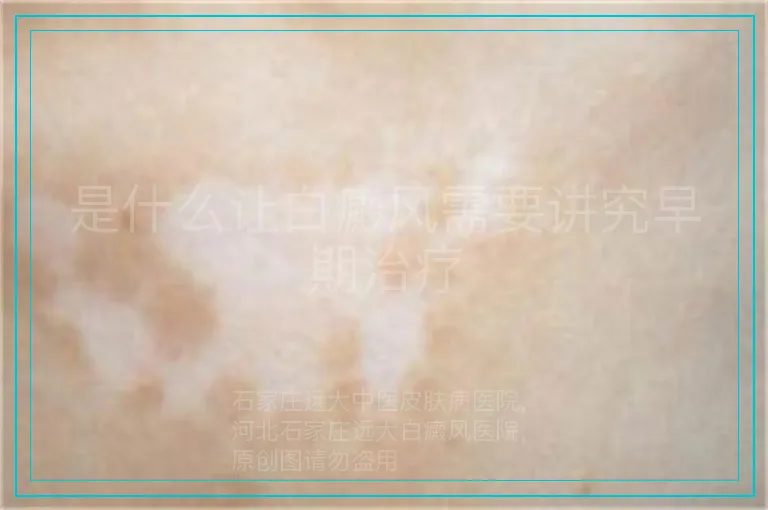 是什么让白癜风需要讲究早期治疗