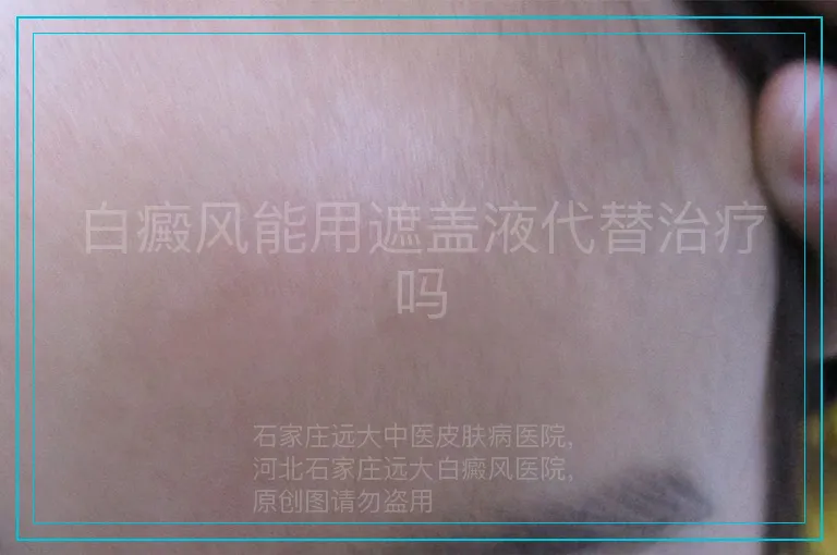 白癜风能用遮盖液代替治疗吗