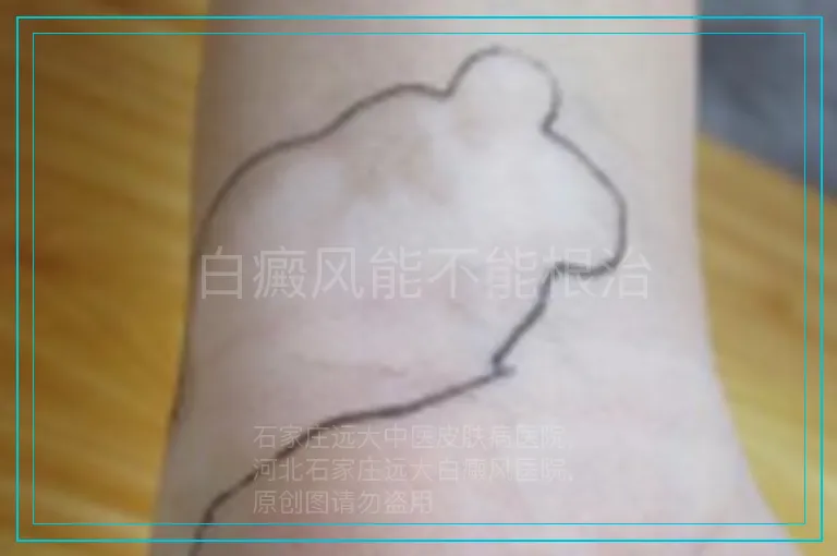 白癜风能不能根治