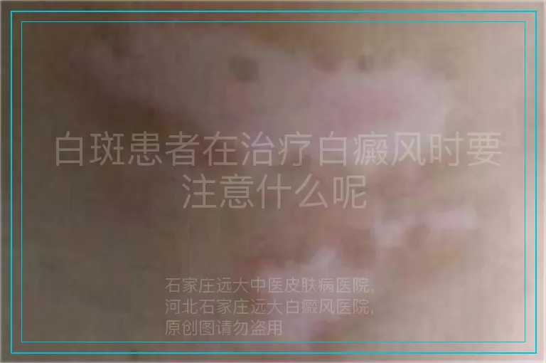 白斑患者在治疗白癜风时要注意什么呢