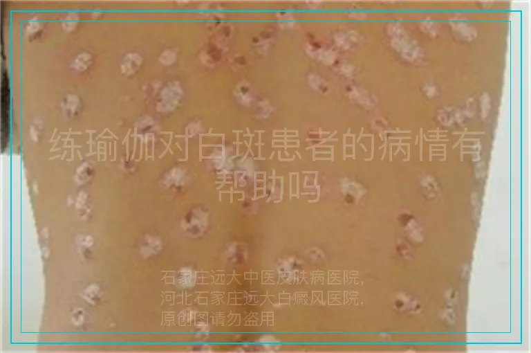 练瑜伽对白斑患者的病情有帮助吗