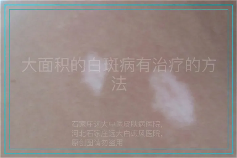 大面积的白斑病有治疗的方法