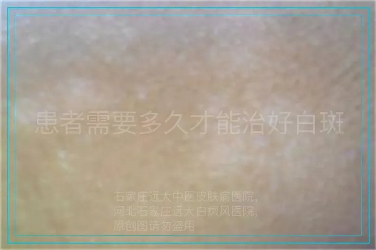 患者需要多久才能治好白斑