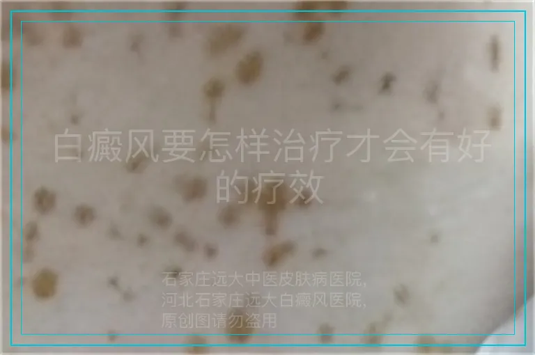 白癜风要怎样治疗才会有好的疗效
