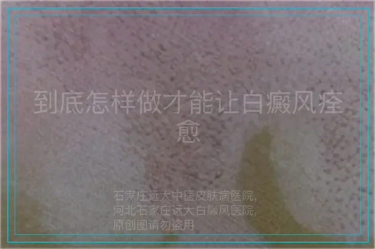 到底怎样做才能让白癜风痊愈