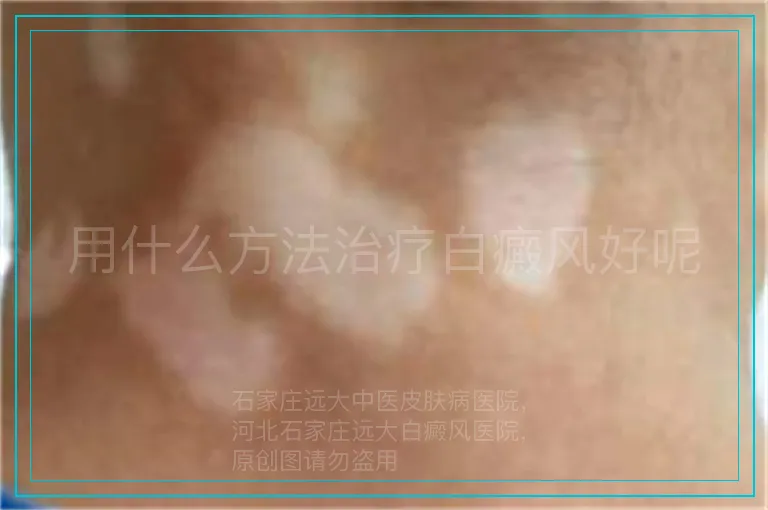 用什么方法治疗白癜风好呢