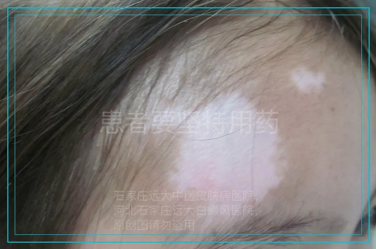 患者要坚持用药
