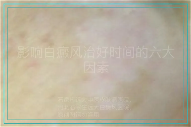 影响白癜风治好时间的六大因素