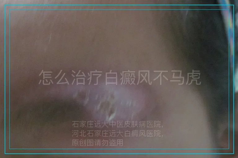 怎么治疗白癜风不马虎