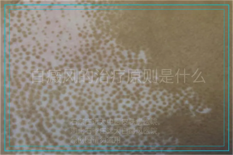 白癜风的治疗原则是什么