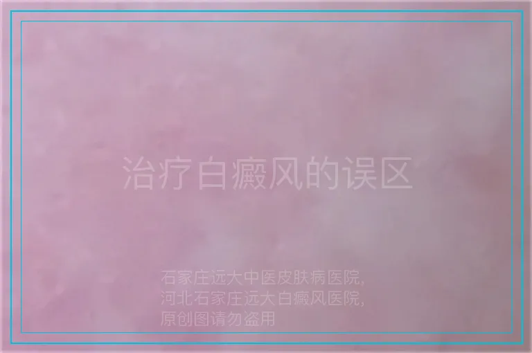 治疗白癜风的误区