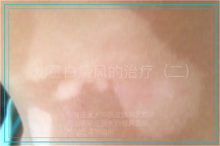 儿童白癜风的治疗（二）