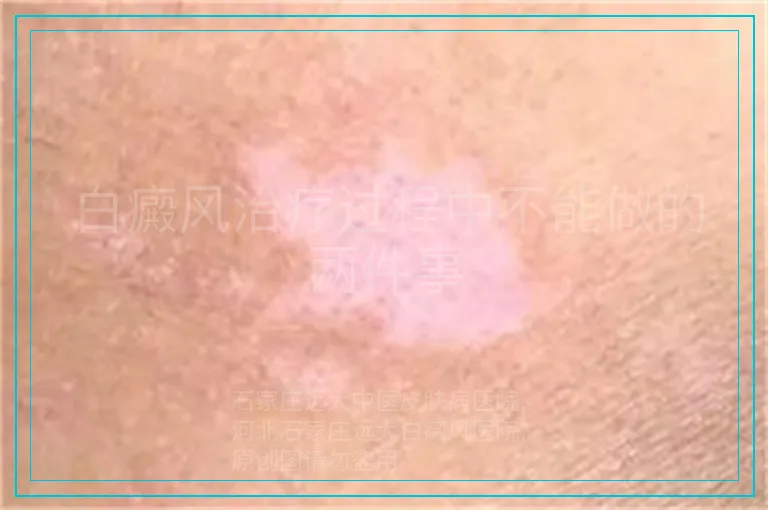 白癜风治疗过程中不能做的两件事