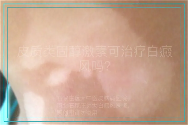皮质类固醇激素可治疗白癜风吗？