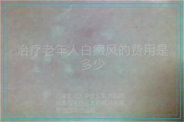 治疗老年人白癜风的费用是多少