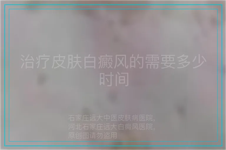 治疗皮肤白癜风的需要多少时间
