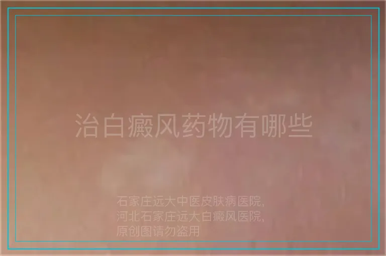 治白癜风药物有哪些