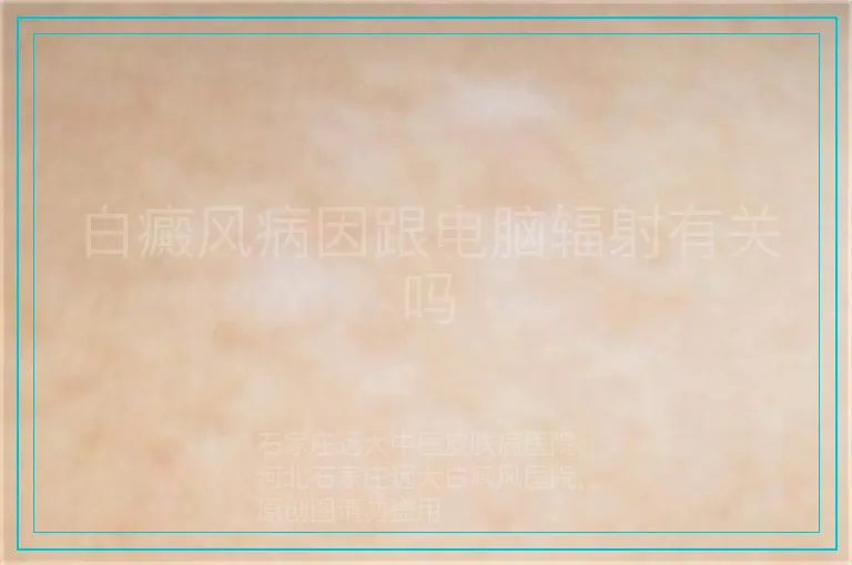 白癜风病因跟电脑辐射有关吗