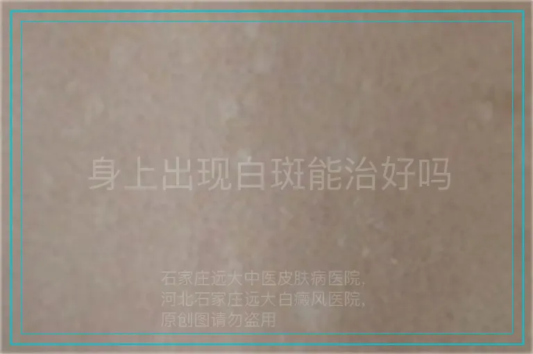 身上出现白斑能治好吗
