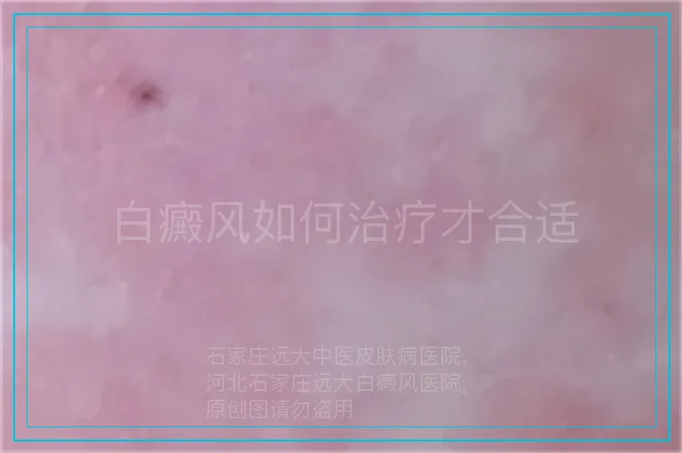 白癜风如何治疗才合适