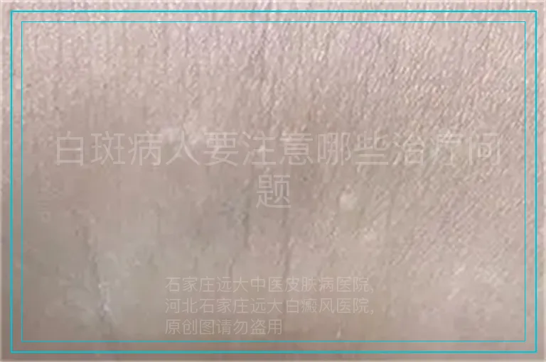 白斑病人要注意哪些治疗问题