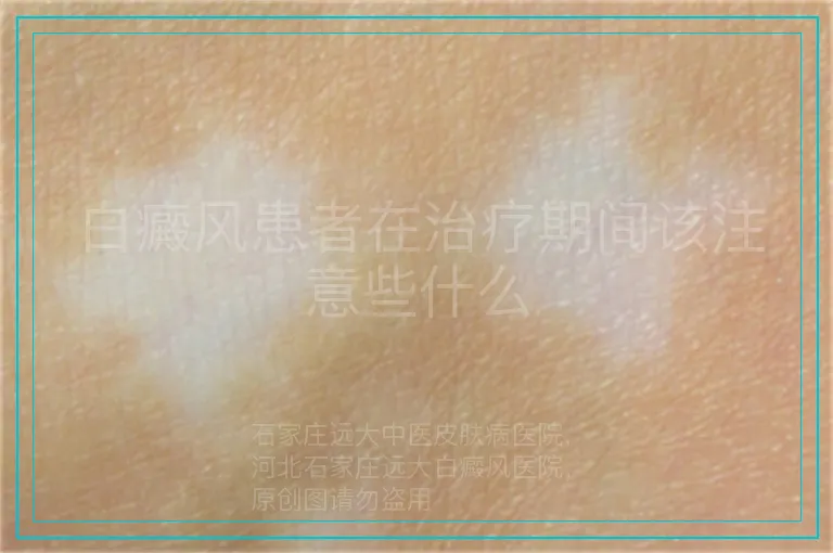 白癜风患者在治疗期间该注意些什么