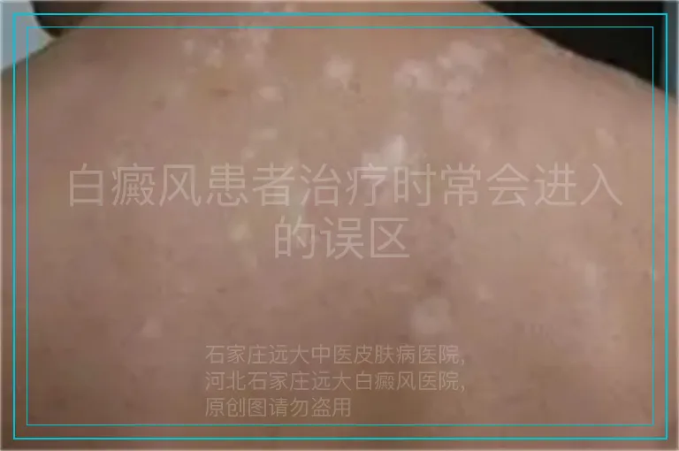 白癜风患者治疗时常会进入的误区