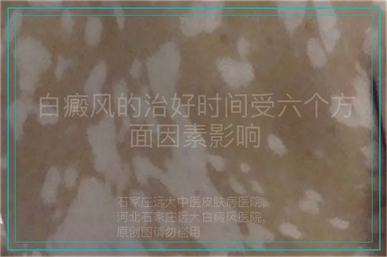 白癜风的治好时间受六个方面因素影响