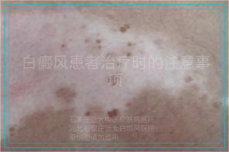 白癜风患者治疗时的注意事项