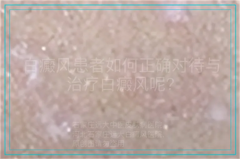 白癜风患者如何正确对待与治疗白癜风呢?