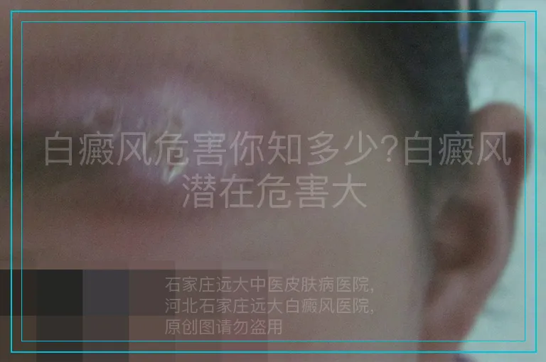 白癜风危害你知多少?白癜风潜在危害大