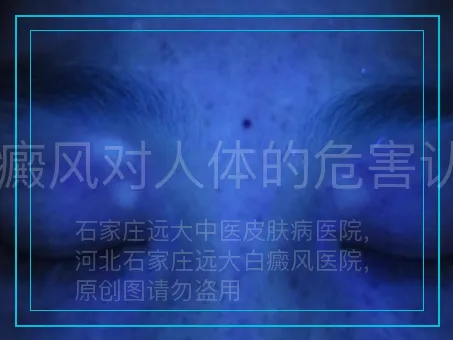 白癜风对人体的危害认知