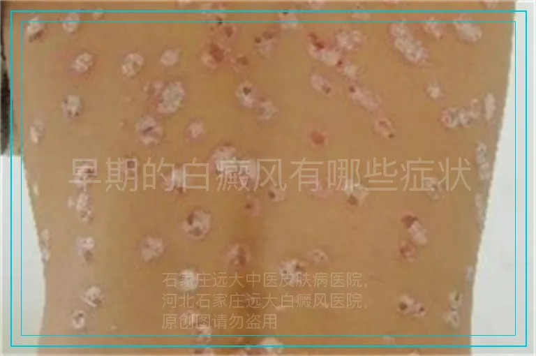 早期的白癜风有哪些症状