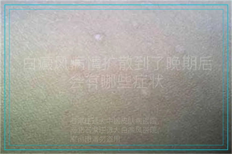 白癜风病情扩散到了晚期后会有哪些症状
