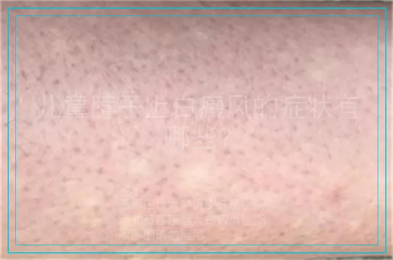 儿童脖子上白癜风的症状有哪些?