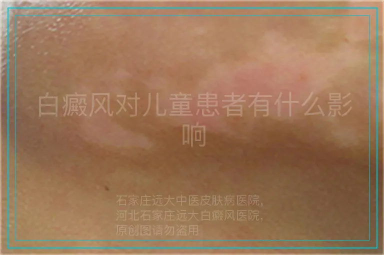白癜风对儿童患者有什么影响