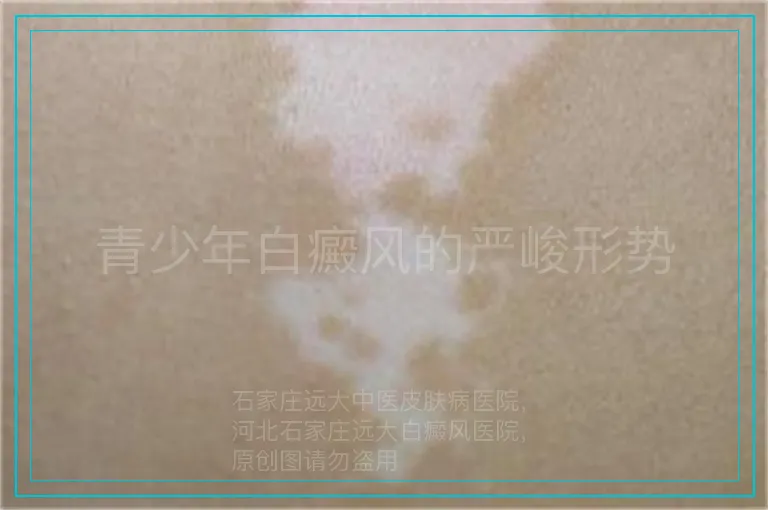 青少年白癜风的严峻形势