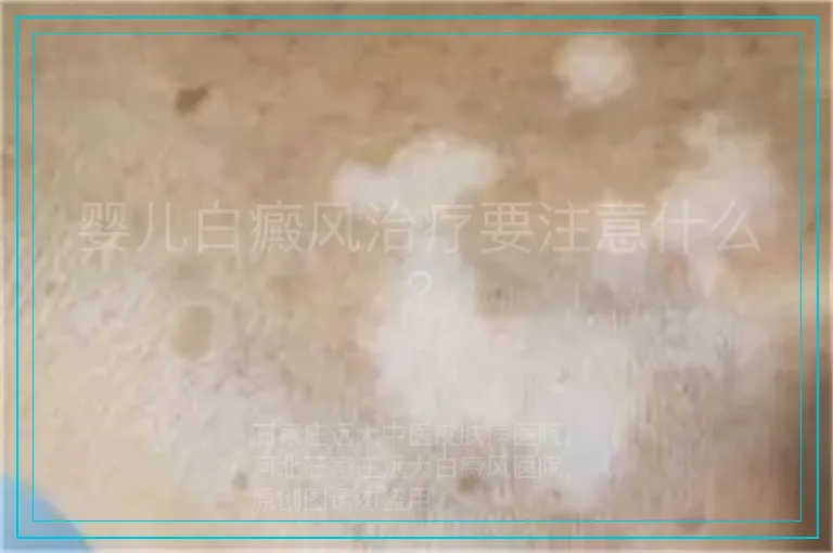 婴儿白癜风治疗要注意什么?