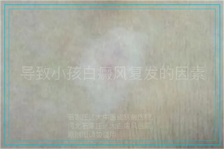 导致小孩白癜风复发的因素