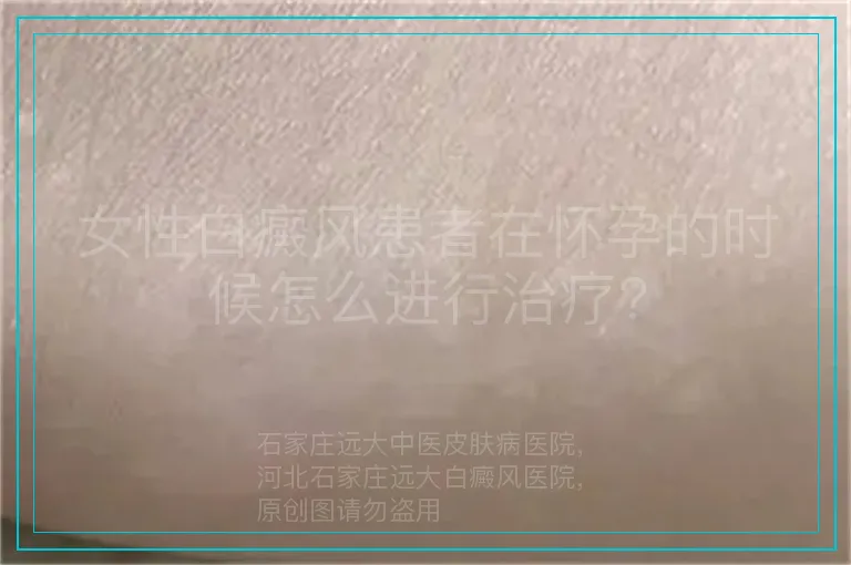女性白癜风患者在怀孕的时候怎么进行治疗?
