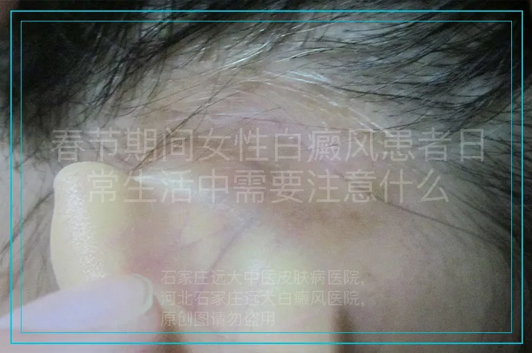 春节期间女性白癜风患者日常生活中需要注意什么