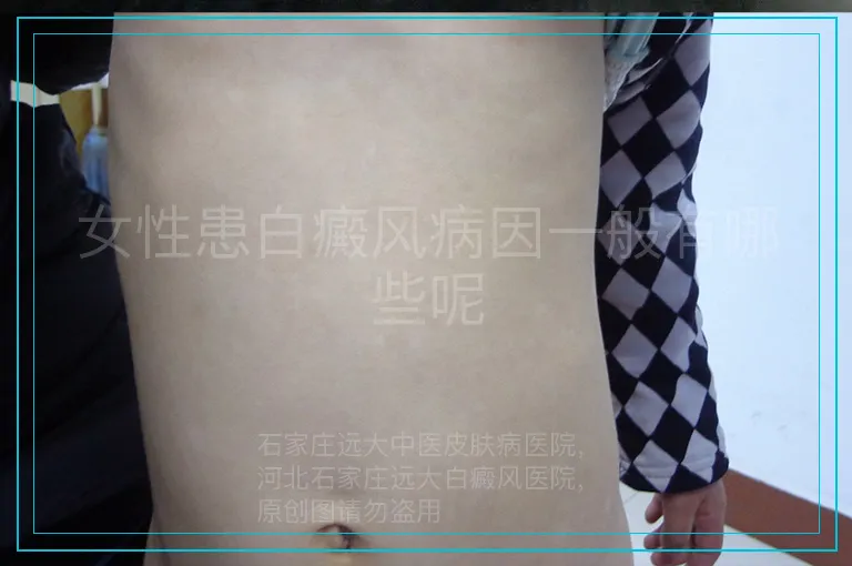 女性患白癜风病因一般有哪些呢