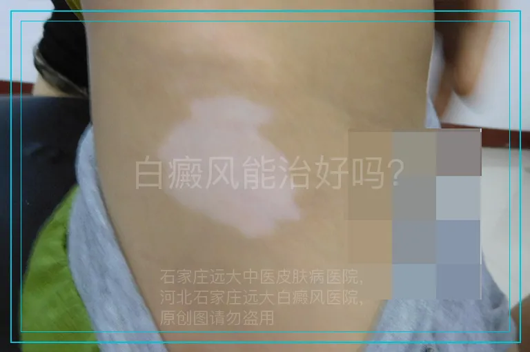 白癜风能治好吗？