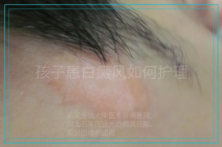 孩子患白癜风如何护理