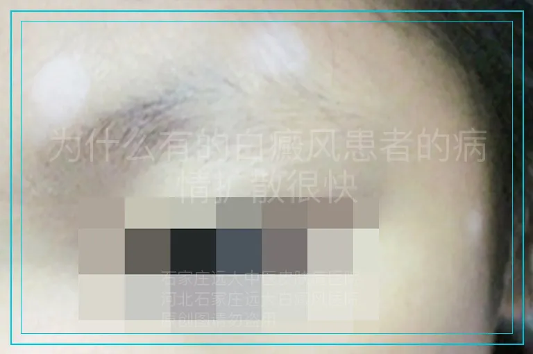 为什么有的白癜风患者的病情扩散很快