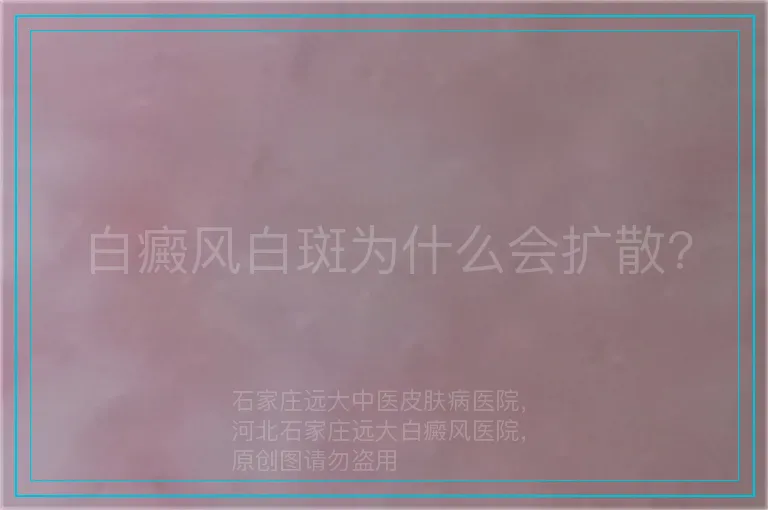 白癜风白斑为什么会扩散?