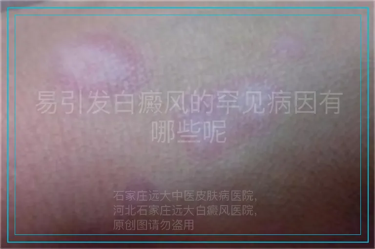 易引发白癜风的罕见病因有哪些呢
