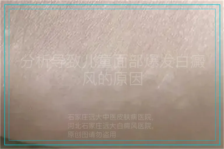 分析导致儿童面部爆发白癜风的原因